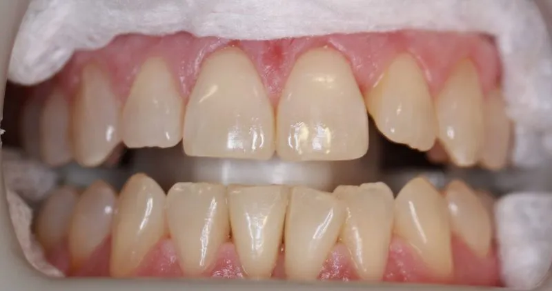 Close-up of teeth with visible wear and discoloration