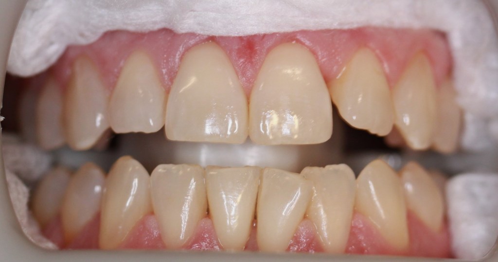 Teeth Whitening Columbus IN Zoom Professional Teeth Whitening