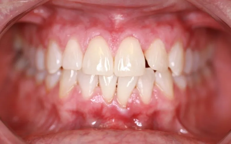 Close-up of teeth with mild crowding and gum inflammation