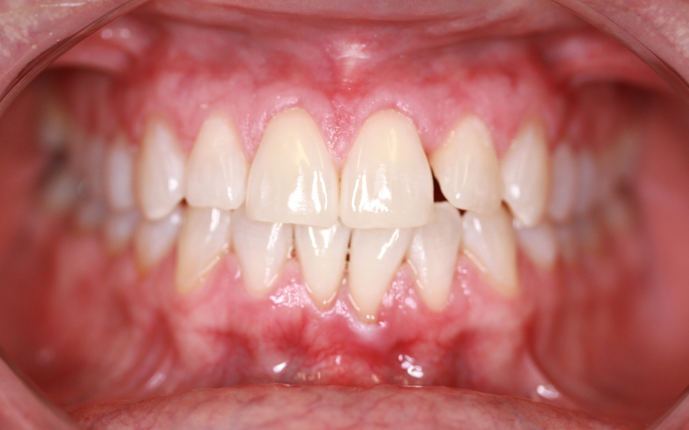 Teeth Whitening Columbus IN Zoom Professional Teeth Whitening