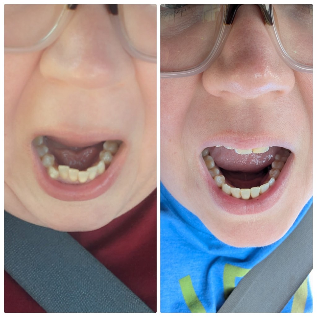 Invisalign before and after