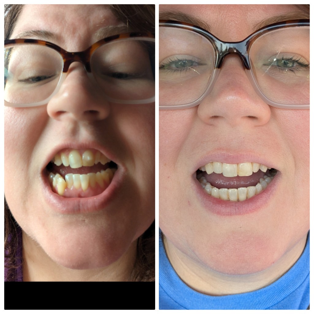 Invisalign before and after