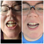 Invisalign before and after