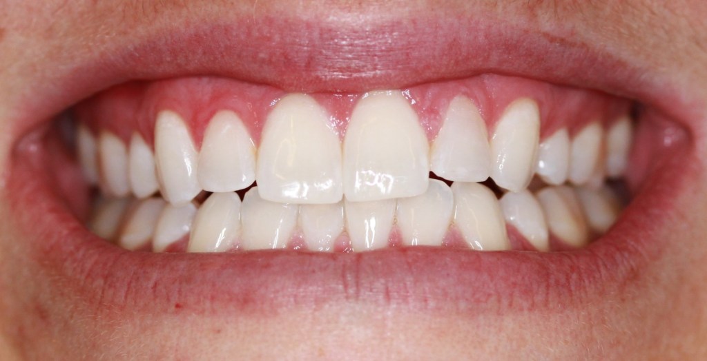 After Zoom Whitening