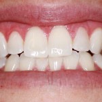 After Zoom Whitening