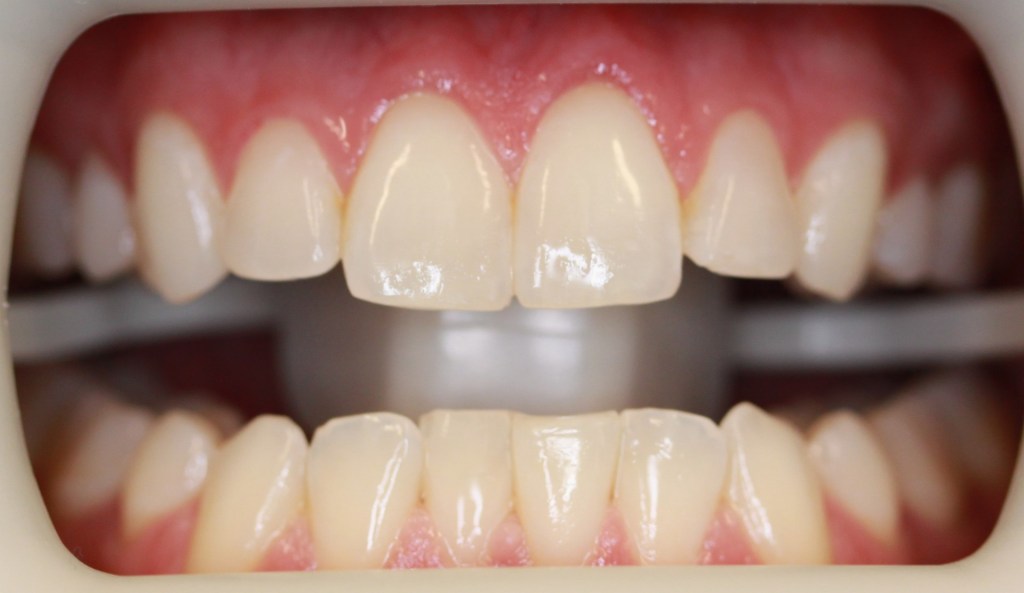 Before Zoom Whitening