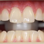 Before Zoom Whitening