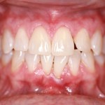 After Zoom Whitening