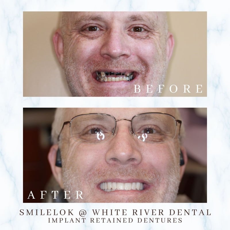 Comparison photos showing a patient before and after receiving implant-retained dentures to restore missing teeth and smile aesthetics.
