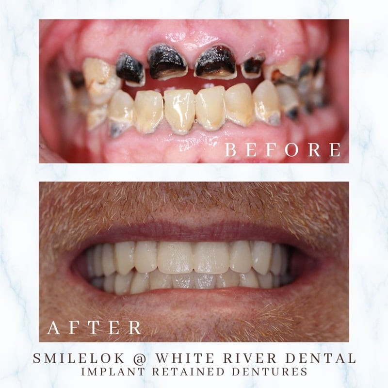Close-up clinical before and after photos showing a dramatic restorative transformation from severely damaged upper teeth to a full set of implant-retained dentures.