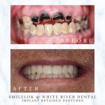 Close-up clinical before and after photos showing a dramatic restorative transformation from severely damaged upper teeth to a full set of implant-retained dentures.
