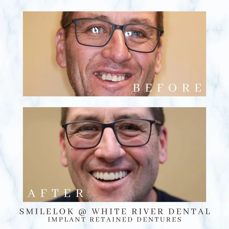 Before and after transformation of a male patient’s smile featuring a complete smile makeover with implant-retained dentures.