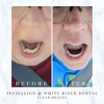 Before and after comparison of a dental patient showing the transition from crowded teeth to a straighter smile using Invisalign clear aligners.