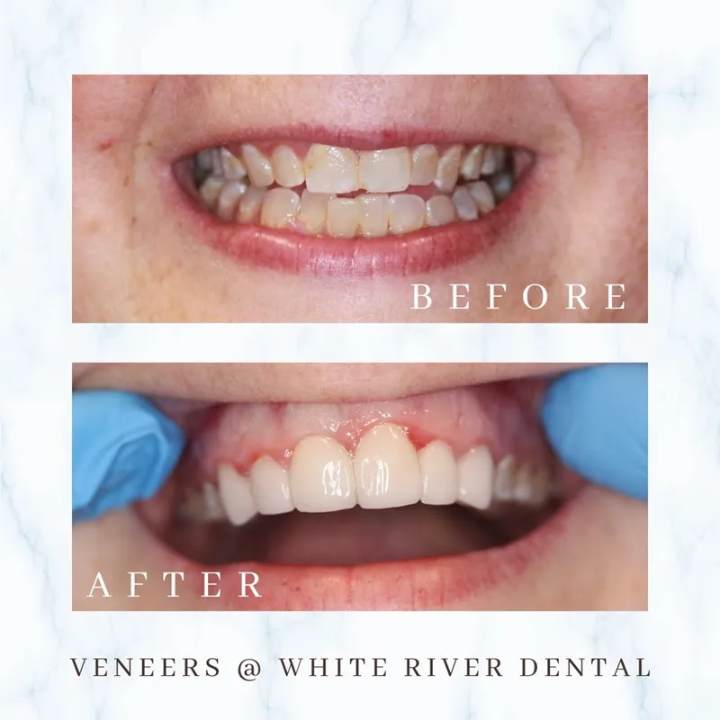 Before and after comparison of a patient’s smile featuring dental veneers used to improve the shape, color, and alignment of the front teeth.