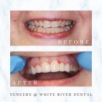 Before and after comparison of a patient’s smile featuring dental veneers used to improve the shape, color, and alignment of the front teeth.