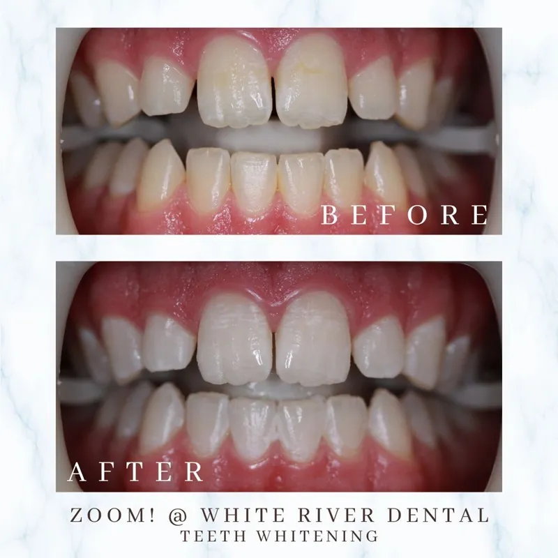 A patient's teeth before and after a professional whitening session, demonstrating a significant improvement in tooth shade and brightness.