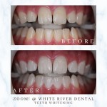 A patient's teeth before and after a professional whitening session, demonstrating a significant improvement in tooth shade and brightness.
