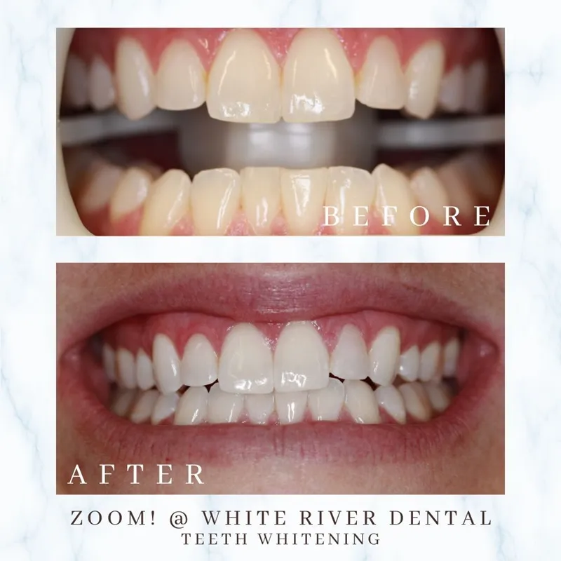 Close-up of a smile before and after a Zoom! whitening treatment, highlighting the transition from a duller shade to a brilliant white.