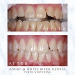 Before and after dental photos showing the professional whitening results on a patient's upper and lower teeth.