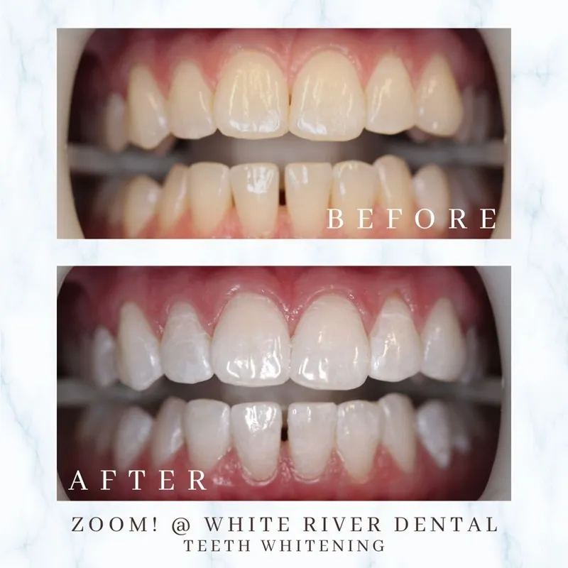 Before and after comparison of a teeth whitening treatment, showing the removal of yellow stains for a brighter, whiter smile.