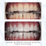 Before and after comparison of a teeth whitening treatment, showing the removal of yellow stains for a brighter, whiter smile.